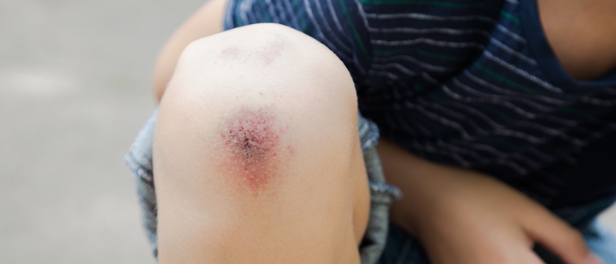 close up of a young boy's knee that is bruised from falling over