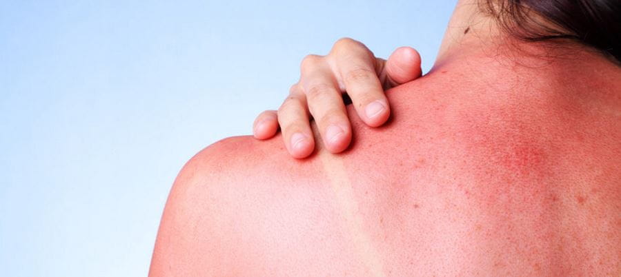 image of a woman with a sunburnt back